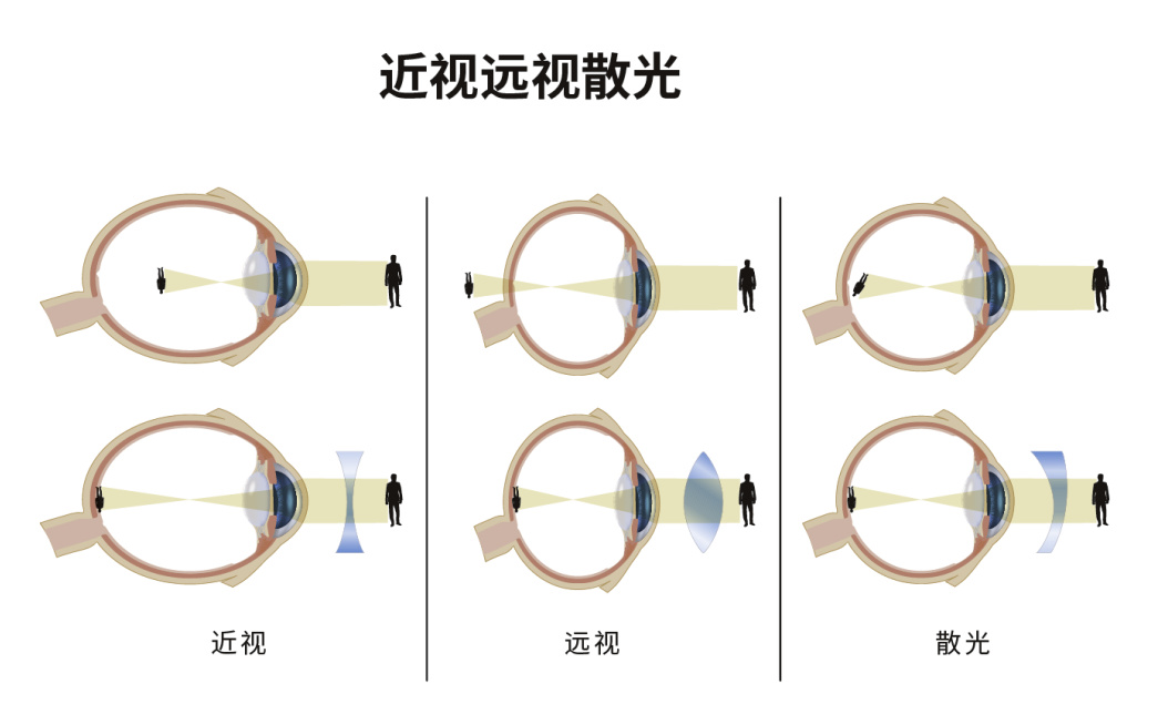 屈光不正.jpg 屈光不正.jpg